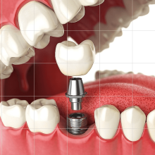 dental implants - services toronto